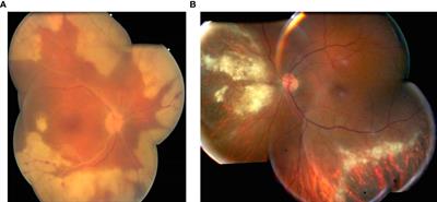 Advances in the microbiological diagnosis of herpetic retinitis